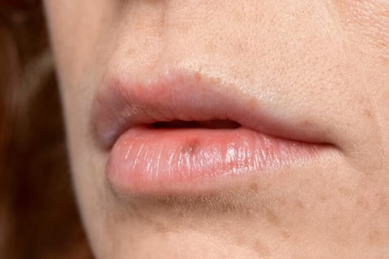 Lip Discoloration