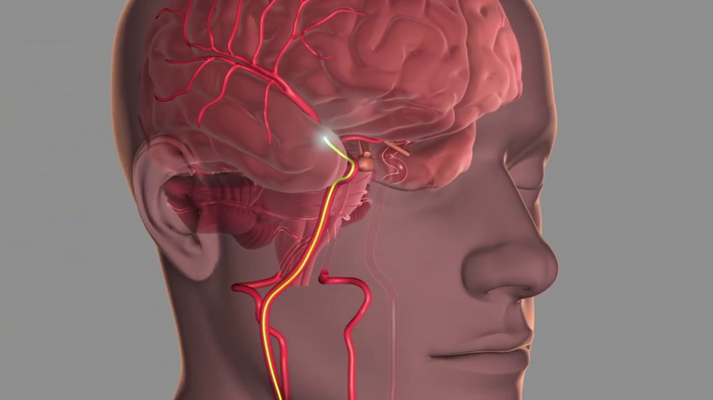 Thrombectomy