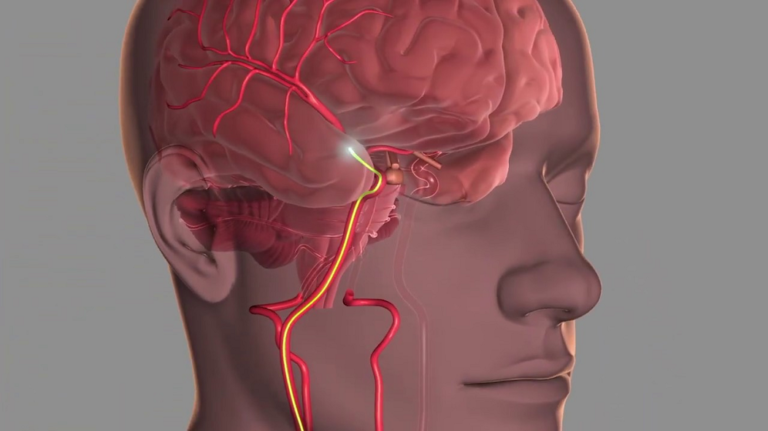 Thrombectomy