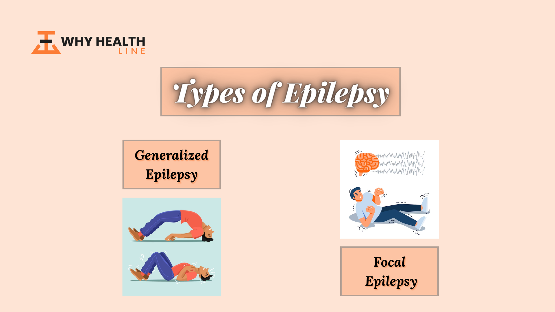 Types of Epilepsy