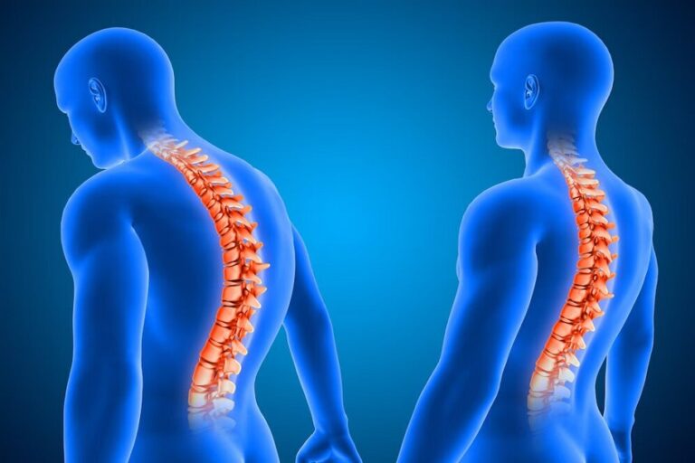 acute spinal cord injury