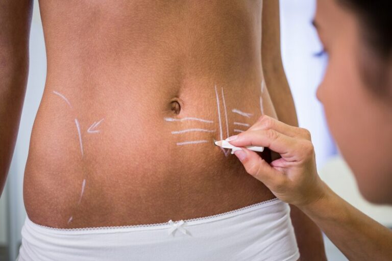 Liposuction Scars