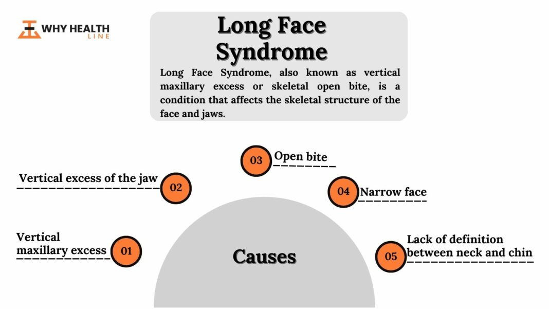 Long Face Syndrome Causes Diagnosis And Treatment   Long Face Syndrome 1 1068x601 