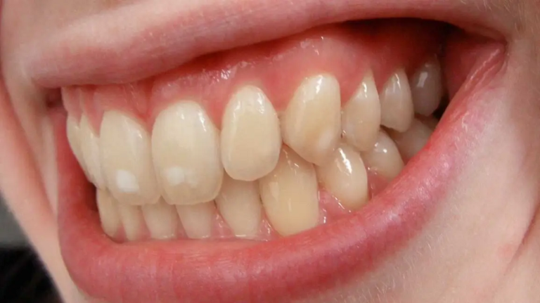 White spots on teeth