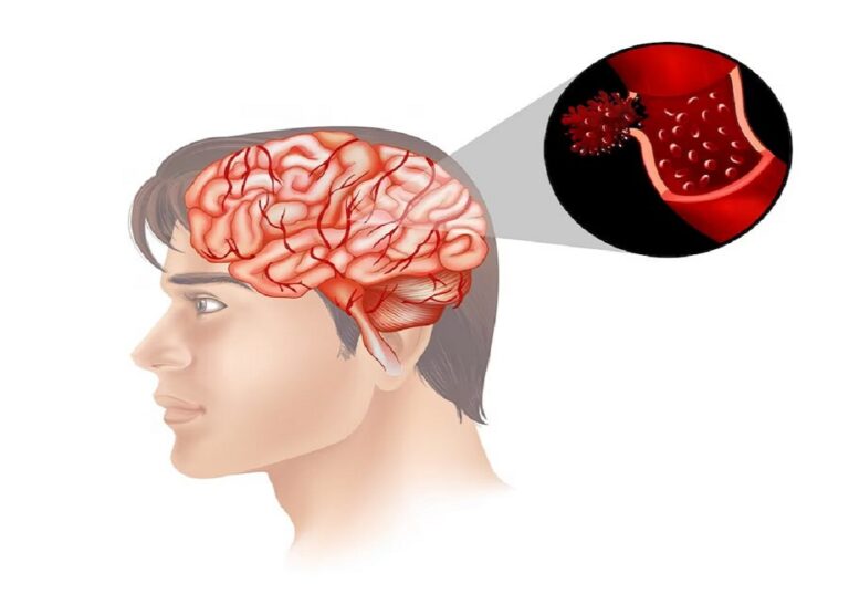 pituitary adenoma symptoms