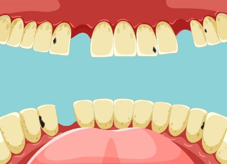 What to Do When You Find a Small Hole in  your Tooth