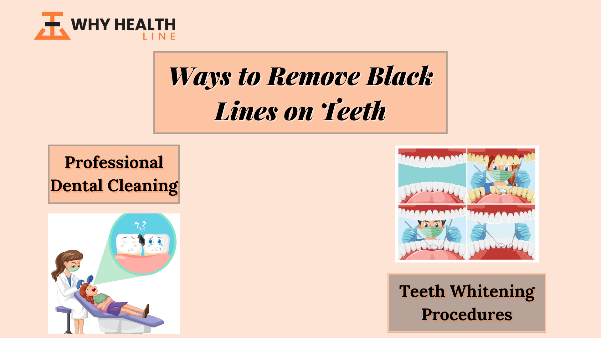 Ways to Remove Black Lines on Teeth